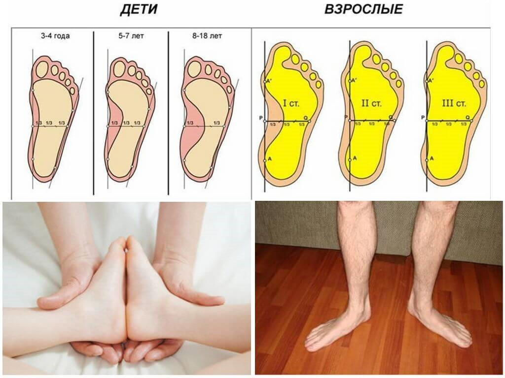 До скольки лет можно исправить. Продольно-поперечное плоскостопие и вальгус 3 степени. Вальгус стопы и поперечное плоскостопие. Продольное плоскостопие деформация стопы. Плоскостопие с вальгусной деформацией стопы.